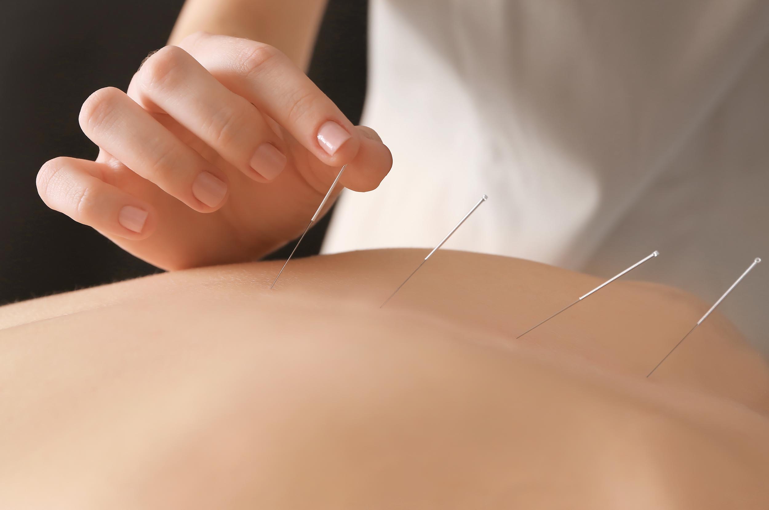 massage therapist placing acupuncture needles in someones back